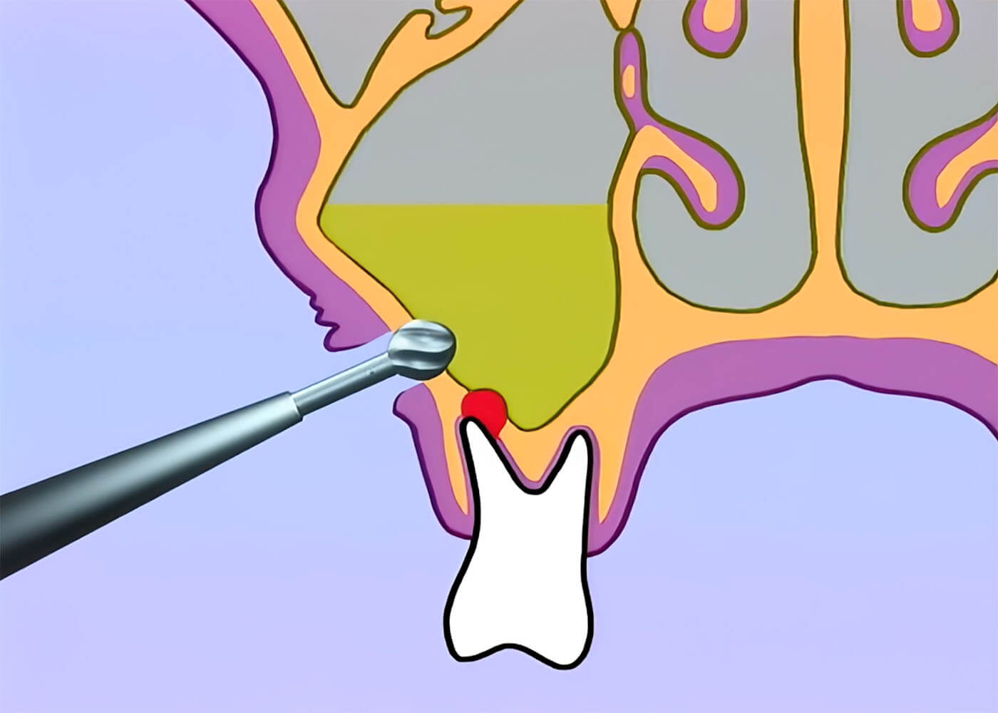 03. Akute Sinusitis maxillaris