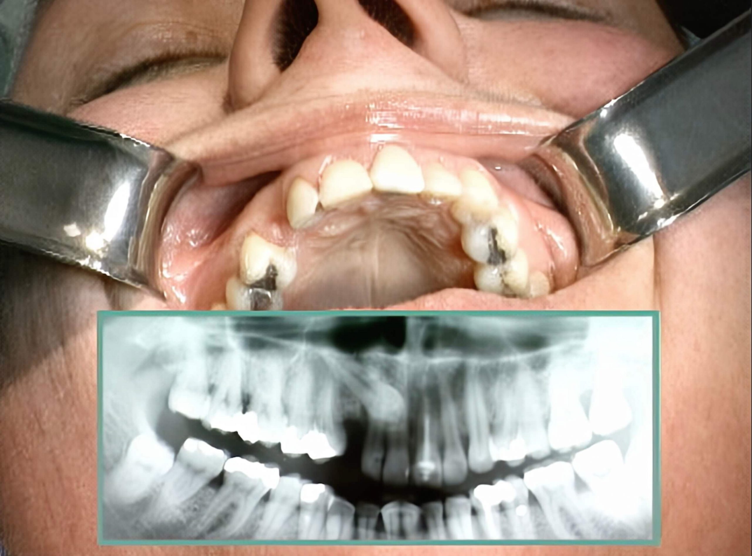 10. Impacted Canines