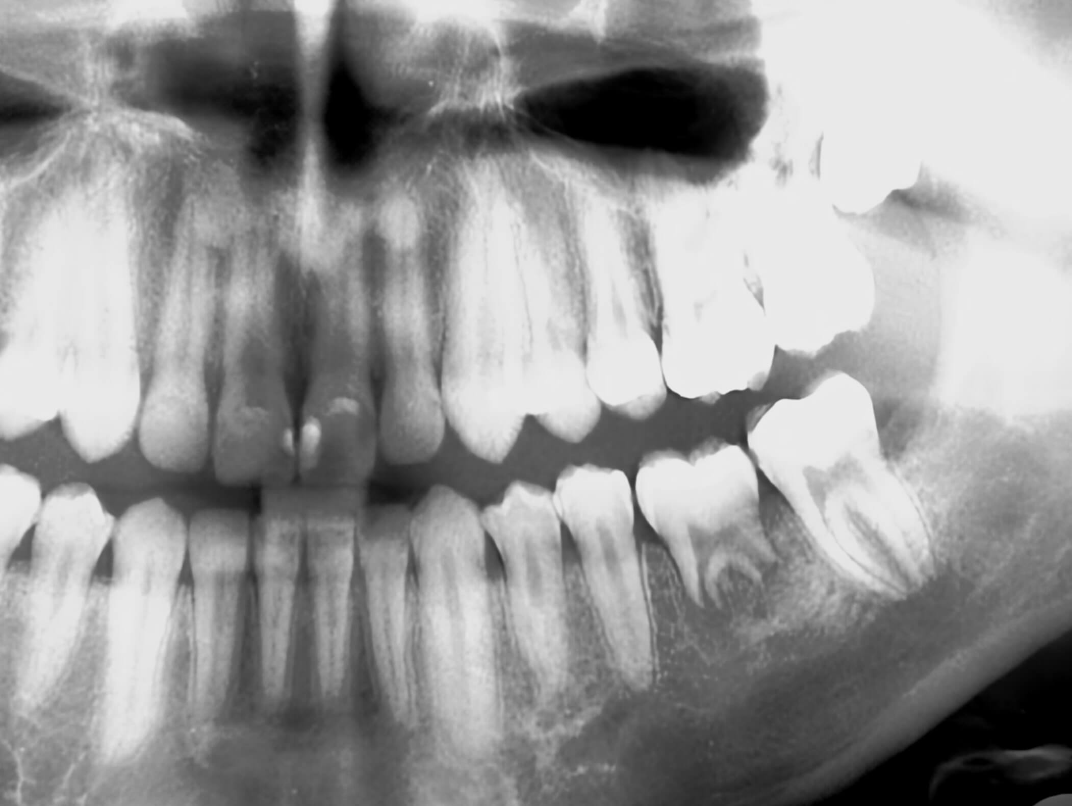 13. Transplantation/Transposition von Weisheitszahnkeimen