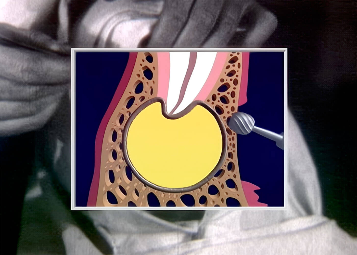 14. Radikuläre Zyste (Zystektomie)
