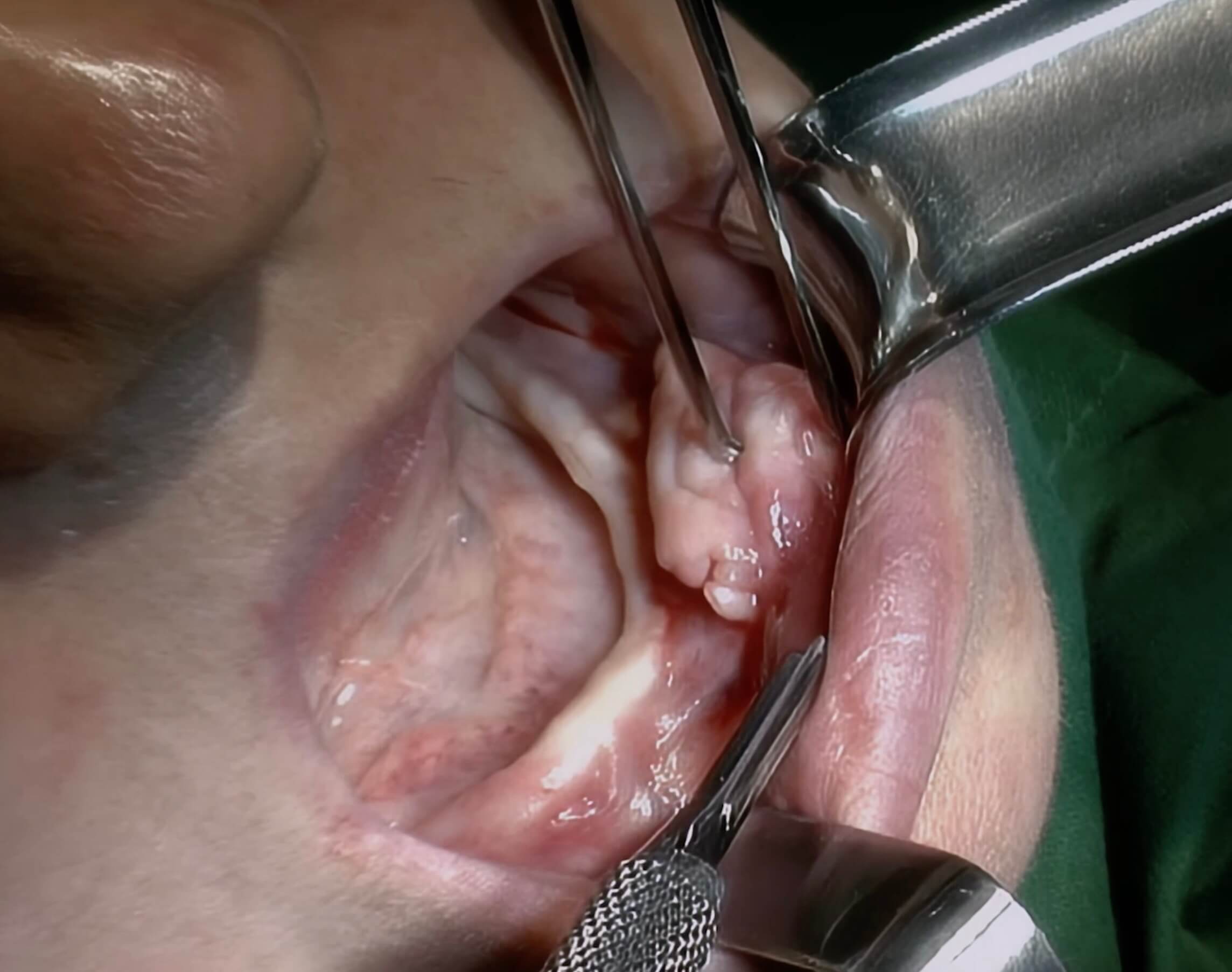 19. Fibromatose und papilläre Hyperplasien