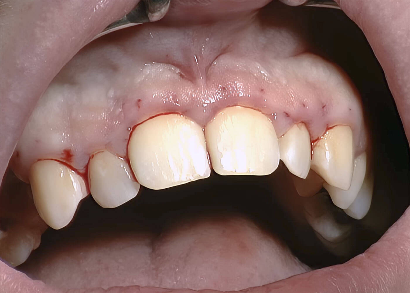 22. Gingivektomie & Gingivoplastik