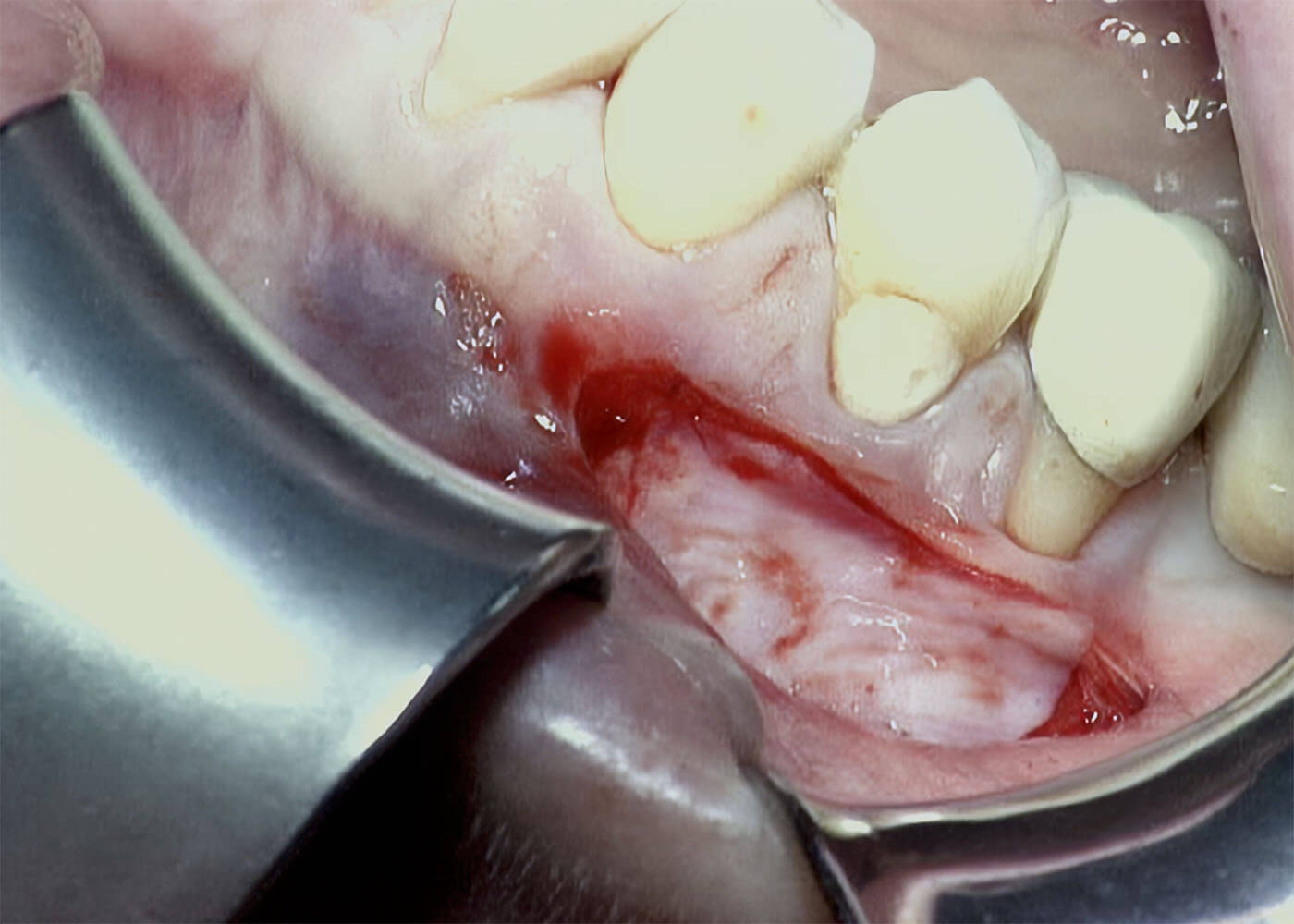 23. Gingivaextension mit Freiem Schleimhauttransplantat (FST) bei Gingivarezession